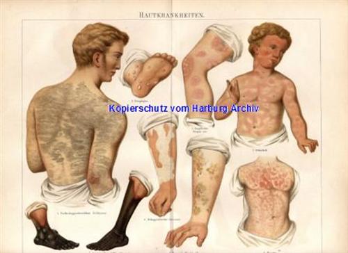 Orig.-Stich aus 1893: Hautkrankheiten
